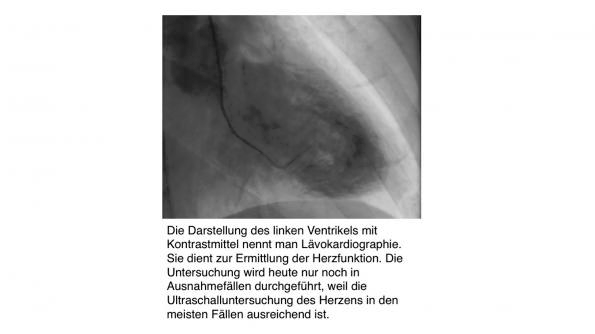 Lävokardiographie